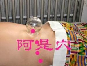 阿是穴