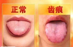 齿痕舌