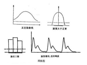 滑脉 滑脉