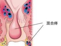 痔