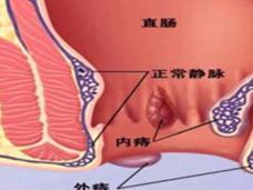 痔