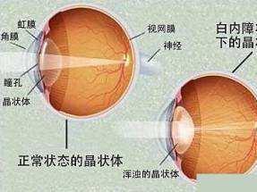 白内障