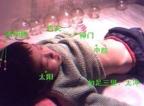 迟发性运动障碍