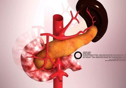 急性胰腺炎