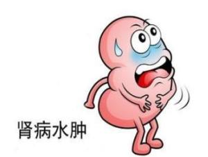 肾病综合征