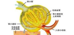 肾病综合征