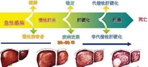 肝硬化