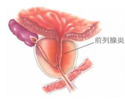 前列腺炎