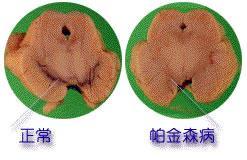 血管性帕金森综合症