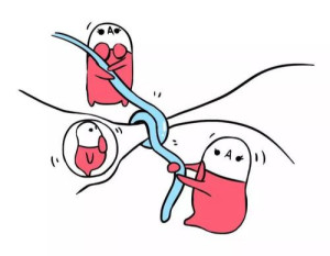 结扎