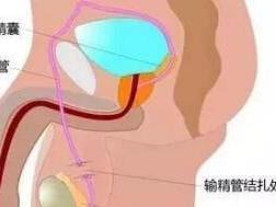 结扎