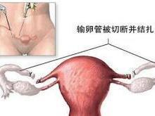 结扎