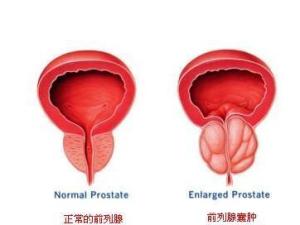 前列腺囊肿