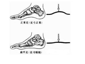 扁平足