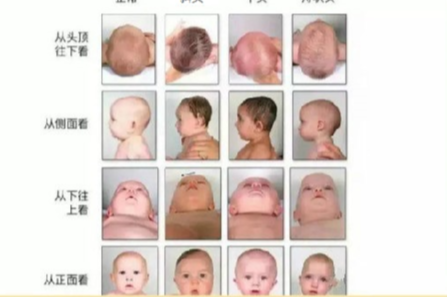 小儿颅面骨畸形综合征