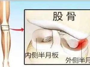 膝关节半月板损伤