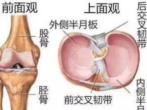 膝关节半月板损伤