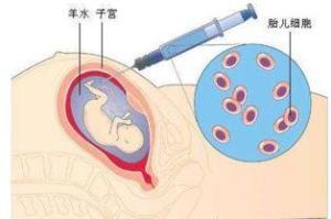 胎膜早破