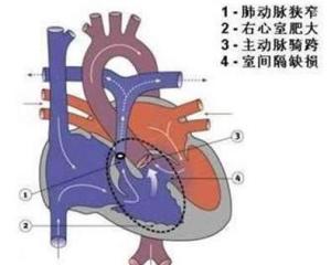 法洛四联症
