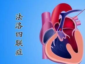 法洛四联症