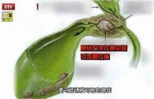 胆囊癌