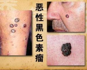 恶性黑色素瘤
