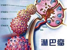 恶性淋巴瘤