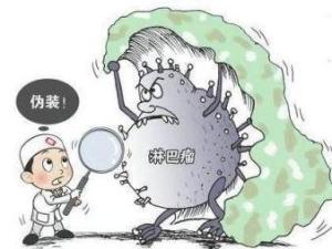 恶性淋巴瘤