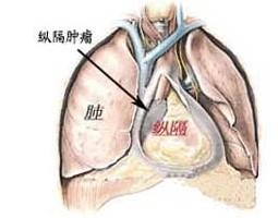 恶性淋巴瘤