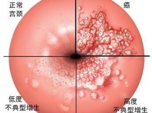 宫颈癌