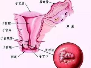 宫颈癌