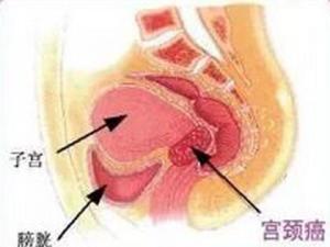 宫颈癌