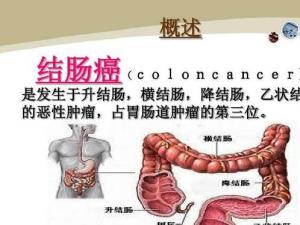 结肠癌