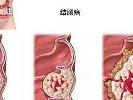 结肠癌