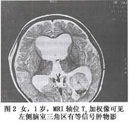 脉络丛乳头状瘤