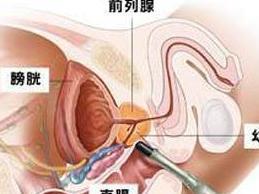 前列腺癌