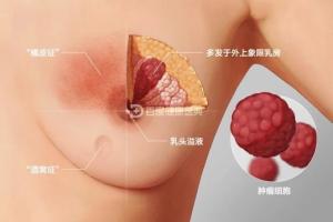 乳腺癌