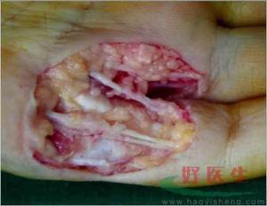 上皮样肉瘤