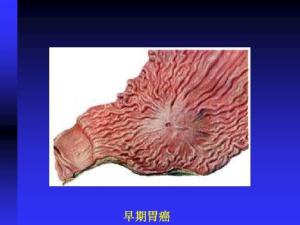 胃癌
