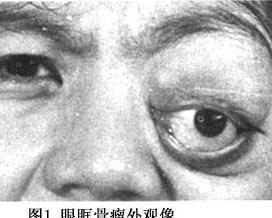 眼眶骨瘤