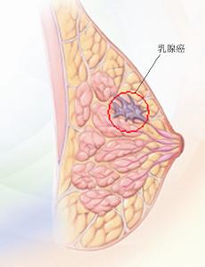 隐匿型乳腺癌