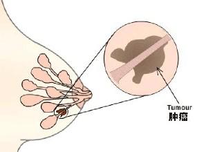 隐匿型乳腺癌
