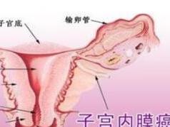 子宫内膜癌