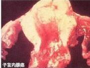 子宫内膜癌