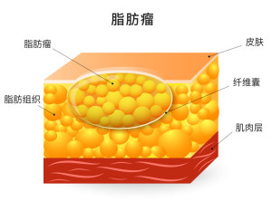 脂肪瘤