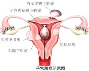子宫肌瘤