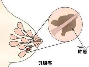 早期乳腺癌