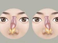 鼻中隔偏曲