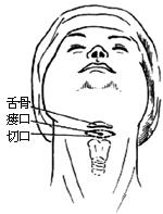 甲状舌骨囊肿与瘘