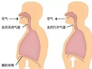 急性会厌炎